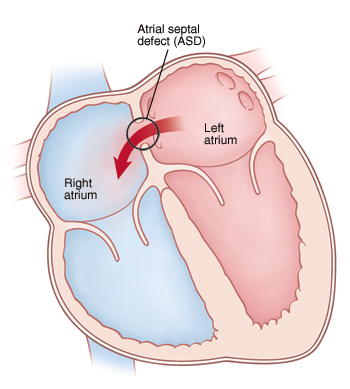 Front view cross section of heart showing atrial septal defect (ASD) allowing blood to flow from left atrium to right atrium.