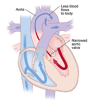 Front view cross section of heart showing aortic stenosis with arrows indicating blood flow through heart.